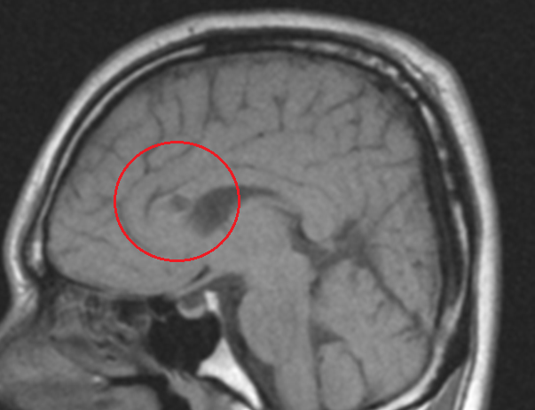 %e3%81%b3%e3%81%be%e3%82%93%e6%80%a7%e8%bb%b8%e7%b4%a2%e6%90%8d%e5%82%b7%e7%94%bb%e5%83%8f