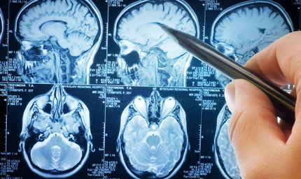 プロスト法律事務所の弁護士だから出来る、脊髄損傷高次脳機能障害の解決