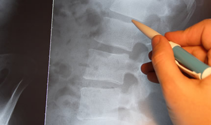 プロスト法律事務所の弁護士だから出来る、脊髄損傷の解決